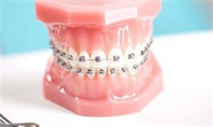 2021正畸托槽行業市場分析及發展前景