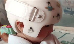 矯正頭盔真能讓寶寶有完美的頭型嗎? 姿勢矯正器行業前景分析
