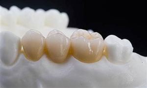 全瓷牙和烤瓷牙哪個(gè)好？全瓷牙多少錢一顆？未來全瓷牙市場規(guī)模預(yù)測?