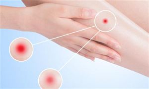 皮膚病治療方法有哪些?皮膚病藥物行業市場行情分析