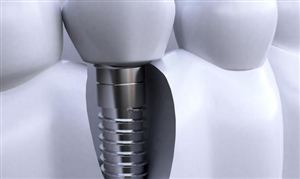 種植牙行業市場消費需求 種植牙行業市場規模分析