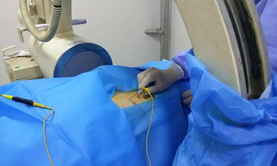 2024年低溫等離子消融技術行業的產業鏈供需布局及發展現狀